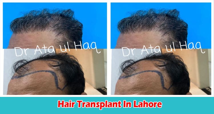 Hair Transplant In Lahore What You Need To Know