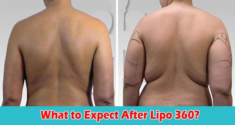 Recovery and Aftercare What to Expect After Lipo 360
