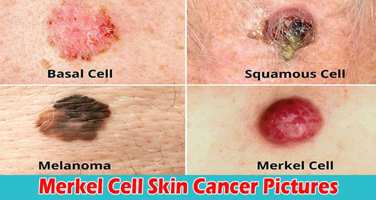 Latest News Merkel Cell Skin Cancer Pictures